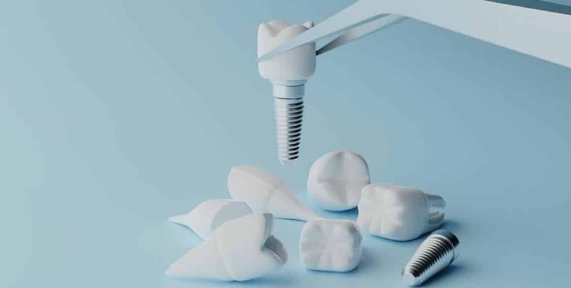 Implanty zębów w UK rodzaje i cena
