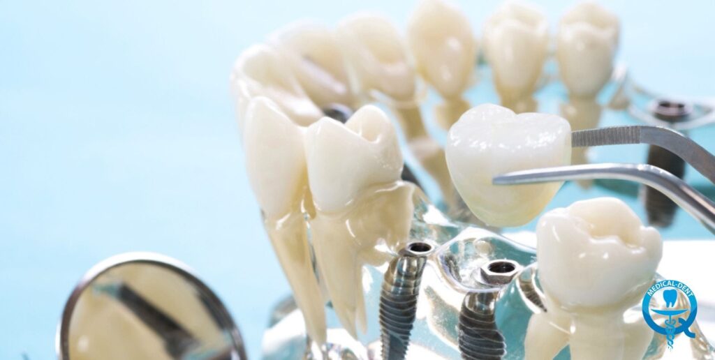 To describe the image, it shows models of teeth and devices used in implant dentistry. Artificial dental crowns made of ceramic material set on titanium implants are visible. These materials are commonly used to restore lost teeth through dental implant procedures. The image shows the specialised tools and components used in dental implantology procedures.