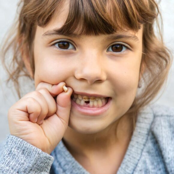 Injuries to deciduous teeth