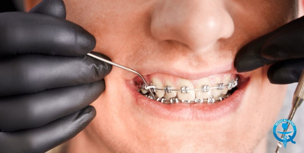 Fotografia prezintă un prim plan al gurii unei persoane care are montat un aparat dentar metalic. Sunt vizibile mâinile dentistului, care folosește instrumente pentru a monta sau ajusta aparatul dentar. Fotografia prezintă un detaliu al procedurii dentare.