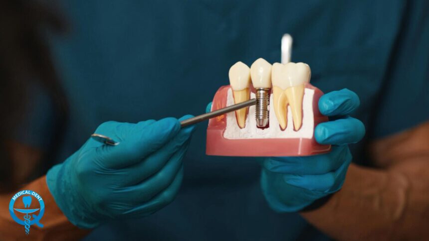 Dental implant - Frequently asked questions and answers